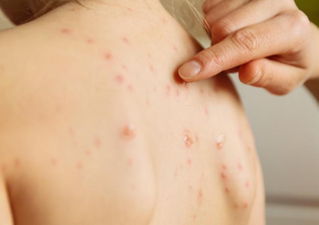 ХӨСҮТ: Улаанбурхан өвчний батлагдсан тохиолдол 22 нэмэгджээ